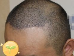 -大麦微针植发丨全国连锁