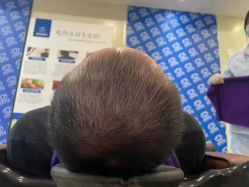 -碧莲盛·不剃发植发