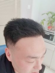 体验后-大麦微针植发丨全国连锁
