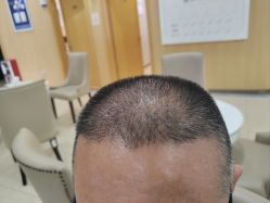 -大麦微针植发全国连锁
