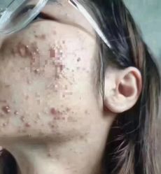 -苗方清颜专业祛痘连锁机构