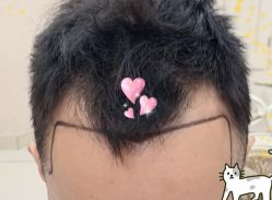 -大麦微针植发全国连锁