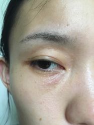 -美丽人生祛斑扁平疣汗管瘤中心