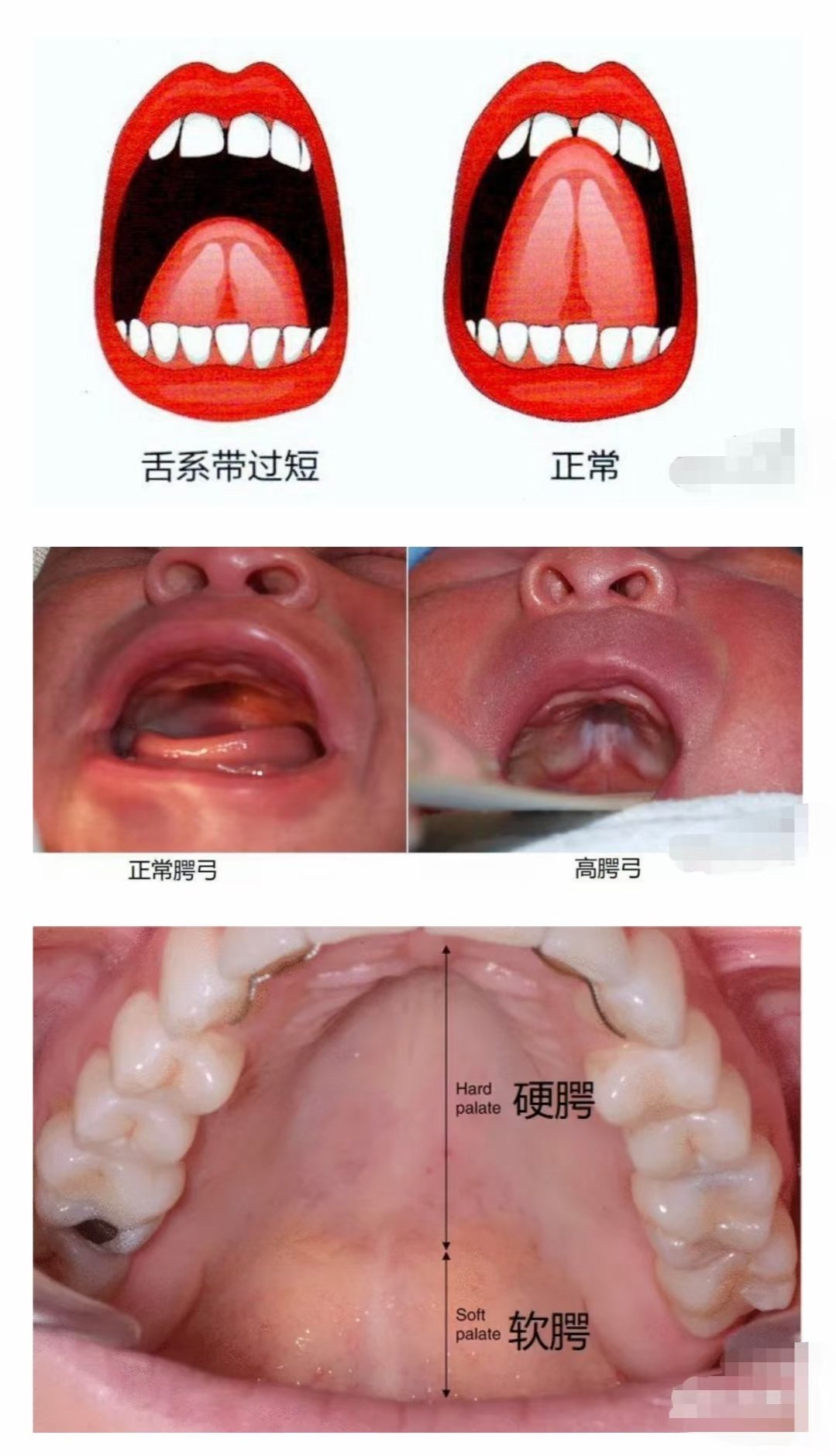 软腭运动图片