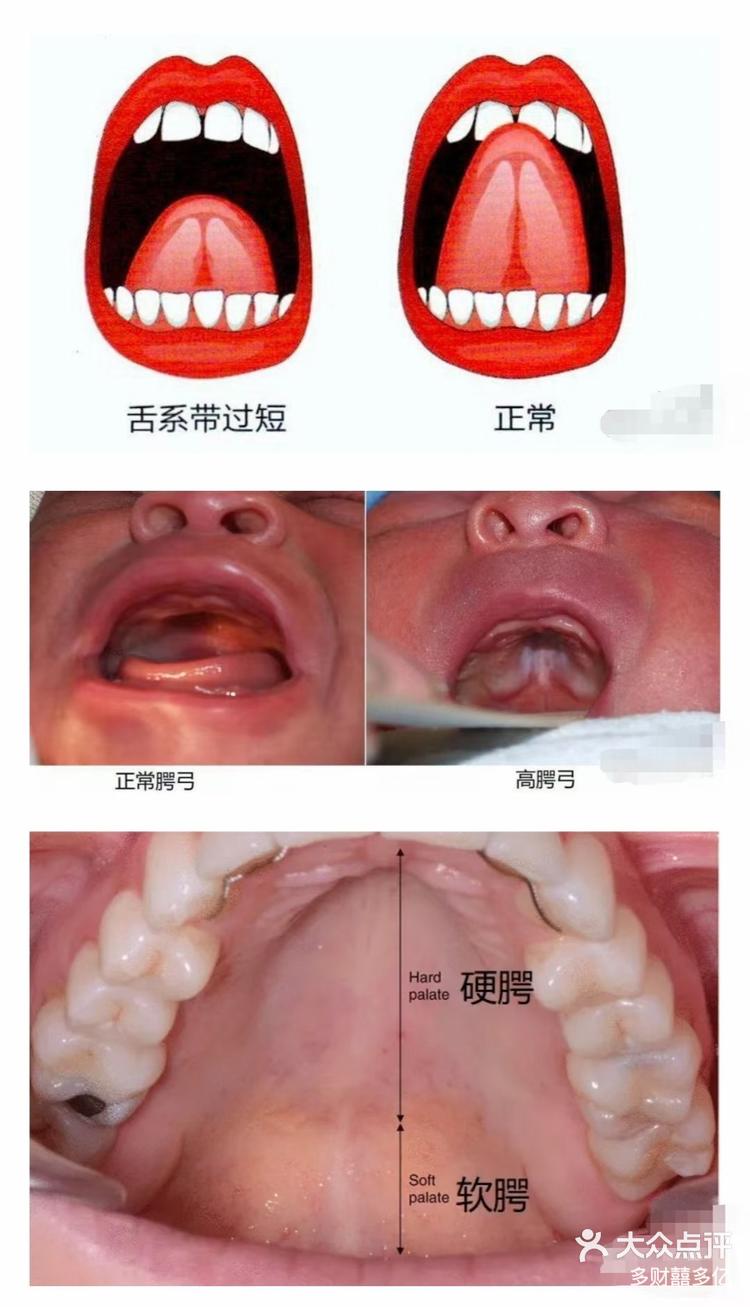 舌腭弓的位置图图片