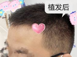 -大麦微针植发全国连锁