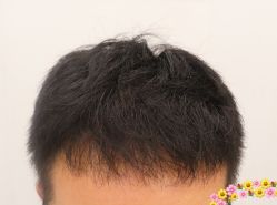 -大麦微针植发全国连锁