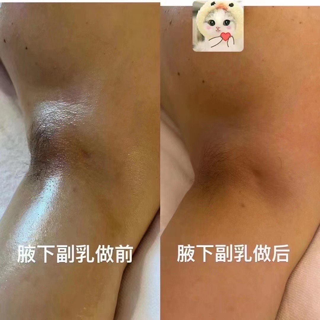 哺乳期副乳图片 腋下图片