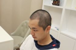 -大麦微针植发丨全国连锁