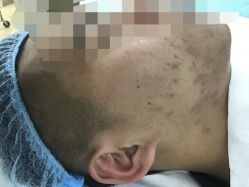 -悟空祛痘·诺奖技术专业店