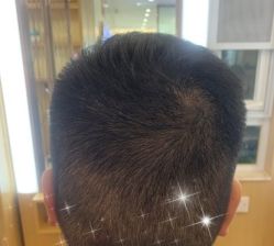 -大麦微针植发全国连锁