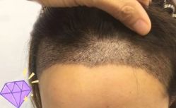 -大麦微针植发丨全国连锁