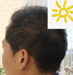 -大麦微针植发丨全国连锁