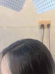 -碧莲盛·不剃发植发