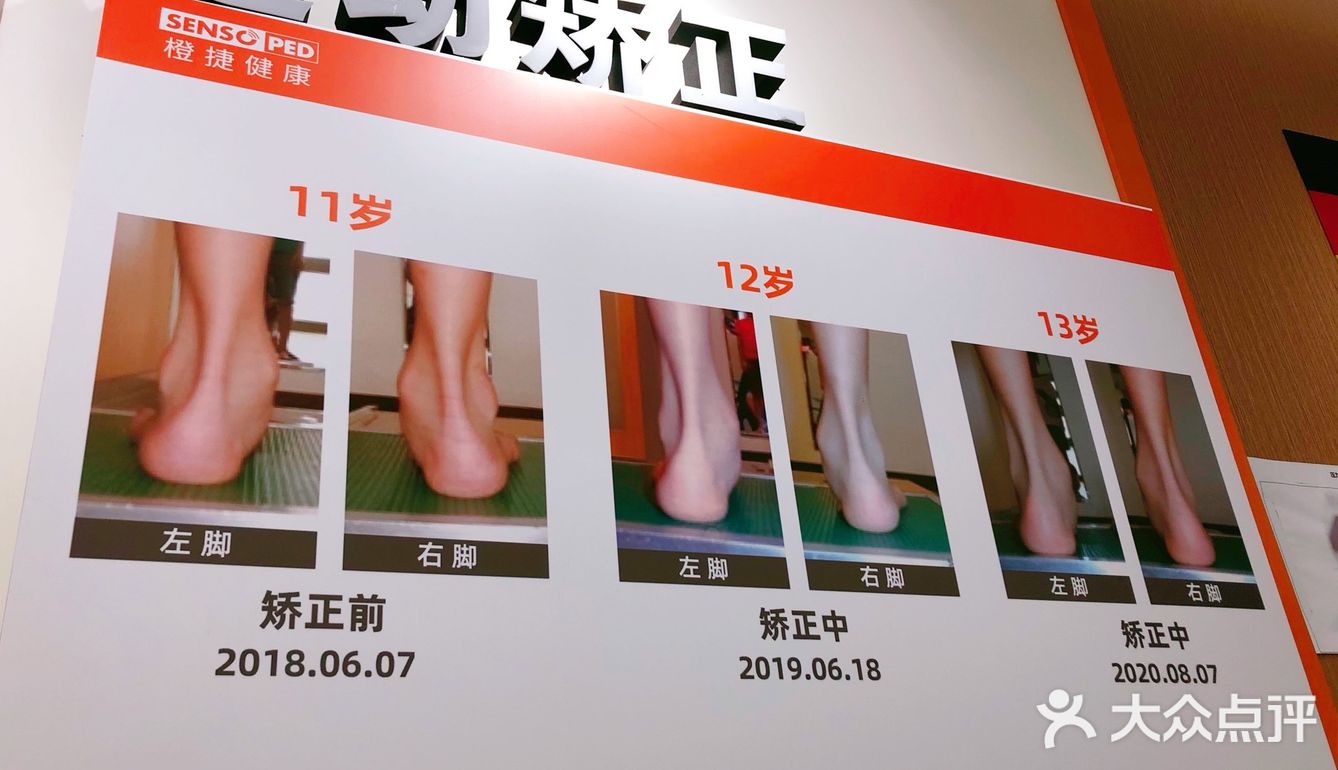 足部矫正找哪家？SENSOPED橙捷足部矫形中心