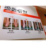 足部矫正找哪家？SENSOPED橙捷足部矫形中心