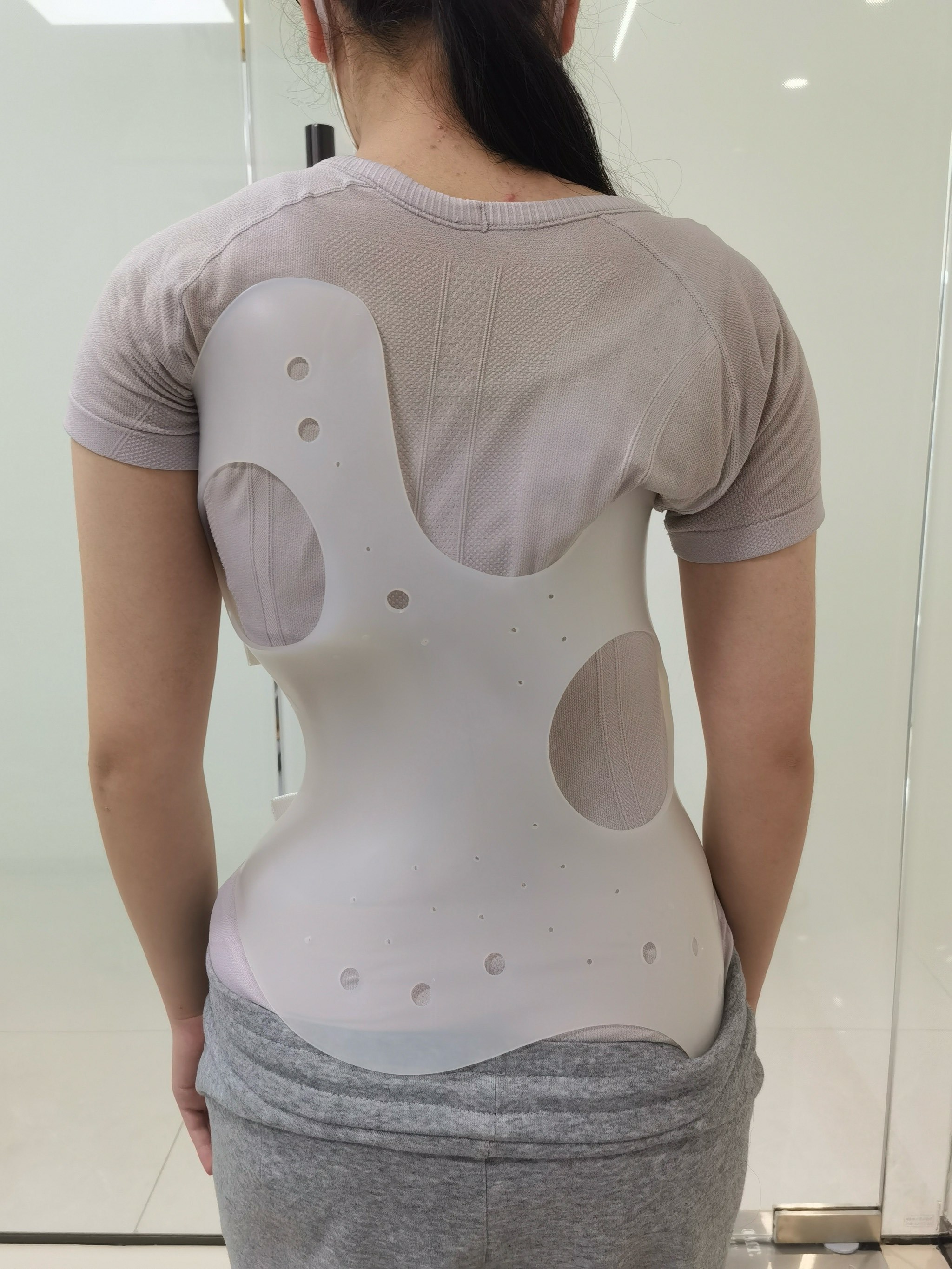 脊柱侧弯支具矫正