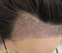 -大麦微针植发丨全国连锁