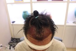 -大麦微针植发丨全国连锁