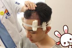 点击看大图 -大麦微针植发丨全国连锁