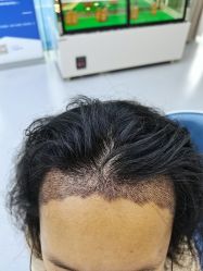 -大麦微针植发全国连锁