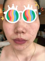 -爱莎扁平疣·汗管瘤·斑痣中心