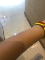 体验后-郑州米兰柏羽集美医疗美容医院