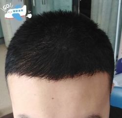 -大麦微针植发丨全国连锁