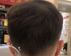-大麦微针植发全国连锁