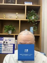 -大麦微针植发全国连锁