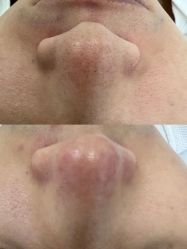 体验前-金品苗方专业祛痘中心