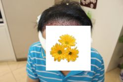 -大麦微针植发丨全国连锁