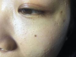 -爱莎扁平疣·汗管瘤·斑痣中心