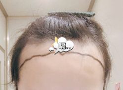 -大麦微针植发全国连锁