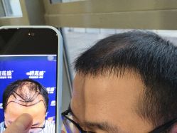 -碧莲盛·不剃发植发