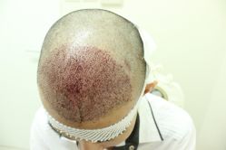 点击看大图 -大麦微针植发丨全国连锁