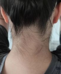 -薇兰专业脱毛连锁机构