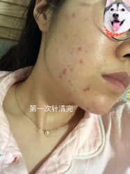 -美肤盾祛痘·问题肌头疗管理中心