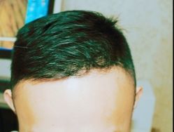 -大麦微针植发丨全国连锁