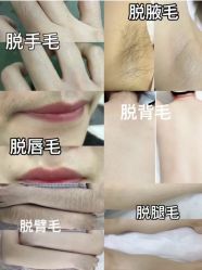 -薇兰专业脱毛连锁机构