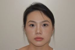 体验后-广州健丽·去眼袋医疗美容机构