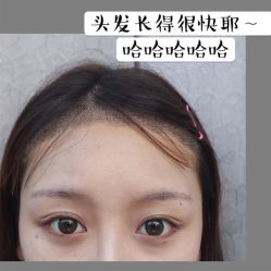 -碧莲盛·不剃发植发