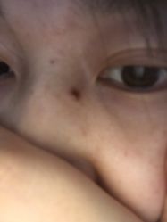 -爱莎扁平疣·汗管瘤·斑痣中心