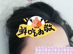 -大麦微针植发全国连锁