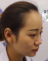 -大麦微针植发全国连锁