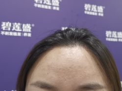 -碧莲盛·不剃发植发