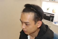 点击看大图 -大麦微针植发丨全国连锁