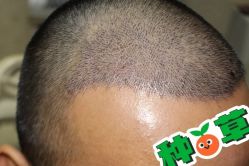 -大麦微针植发丨全国连锁