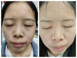 -北京美痣堂古方祛痣斑疣瘊