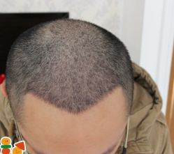 -大麦微针植发丨全国连锁